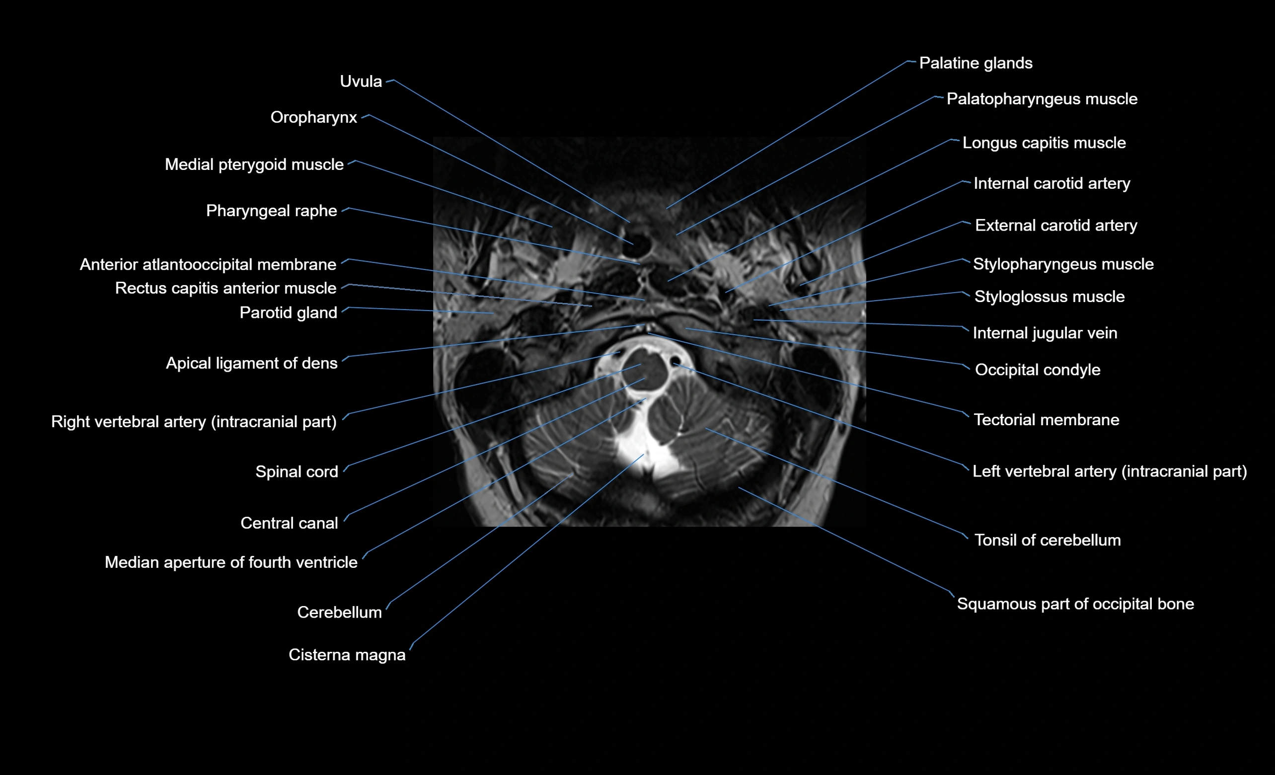 cervical spine cross sectional MRI anatomy  3T MRI axial  image-img-00001-00001.webp